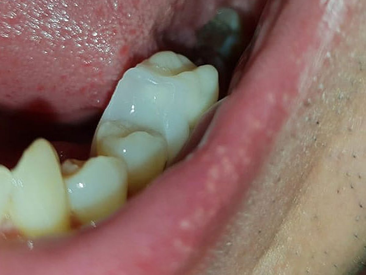 Introducerea protezei Denticor adaptate în locul dintelui posterior lipsă