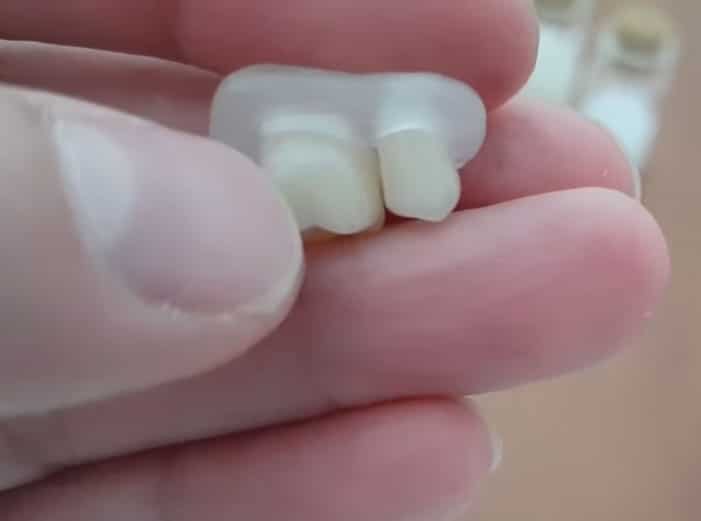Două coroane unite printr-o punte din DentiFlex, vedere din spate