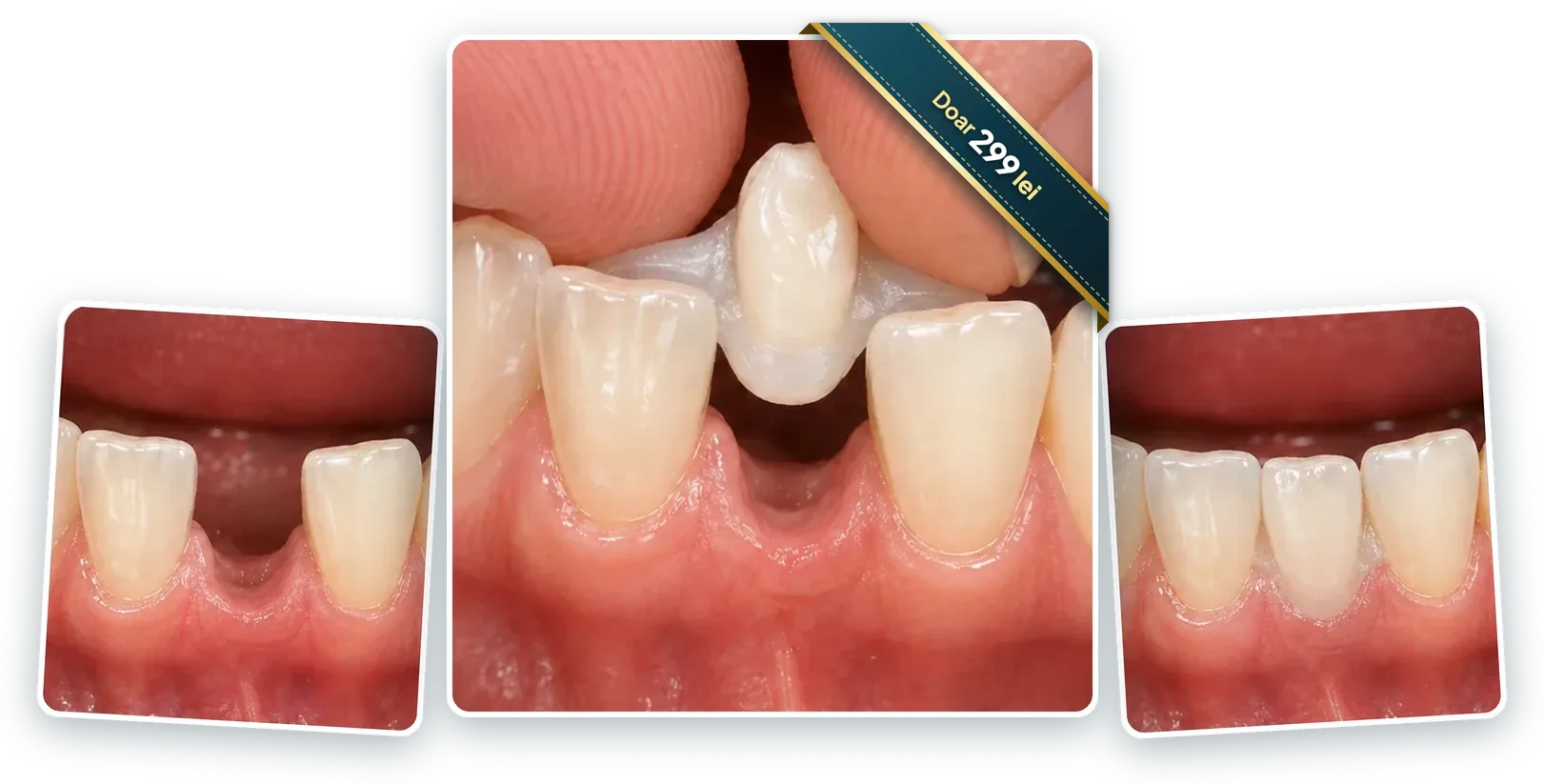 Înainte · Montare · După – Denticor