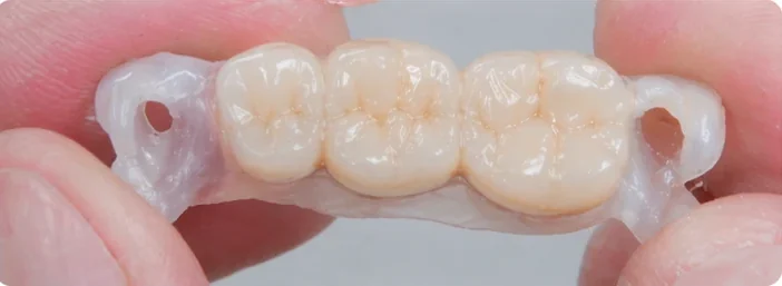 Denticor – Lipsesc trei dinți din spate
