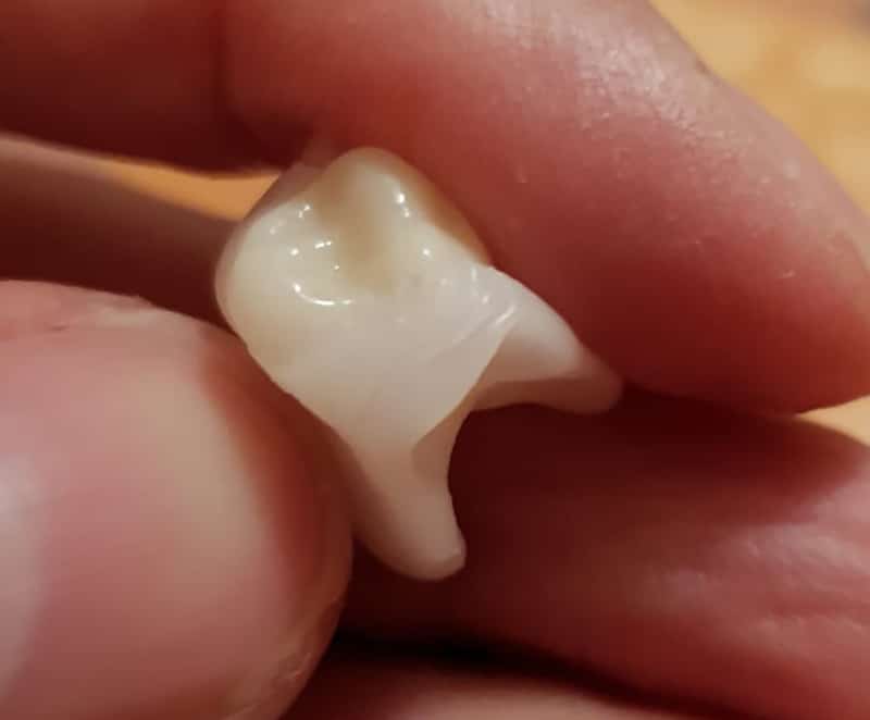 Detaliu al unei coroane Denticor, cu puntea DentiFlex