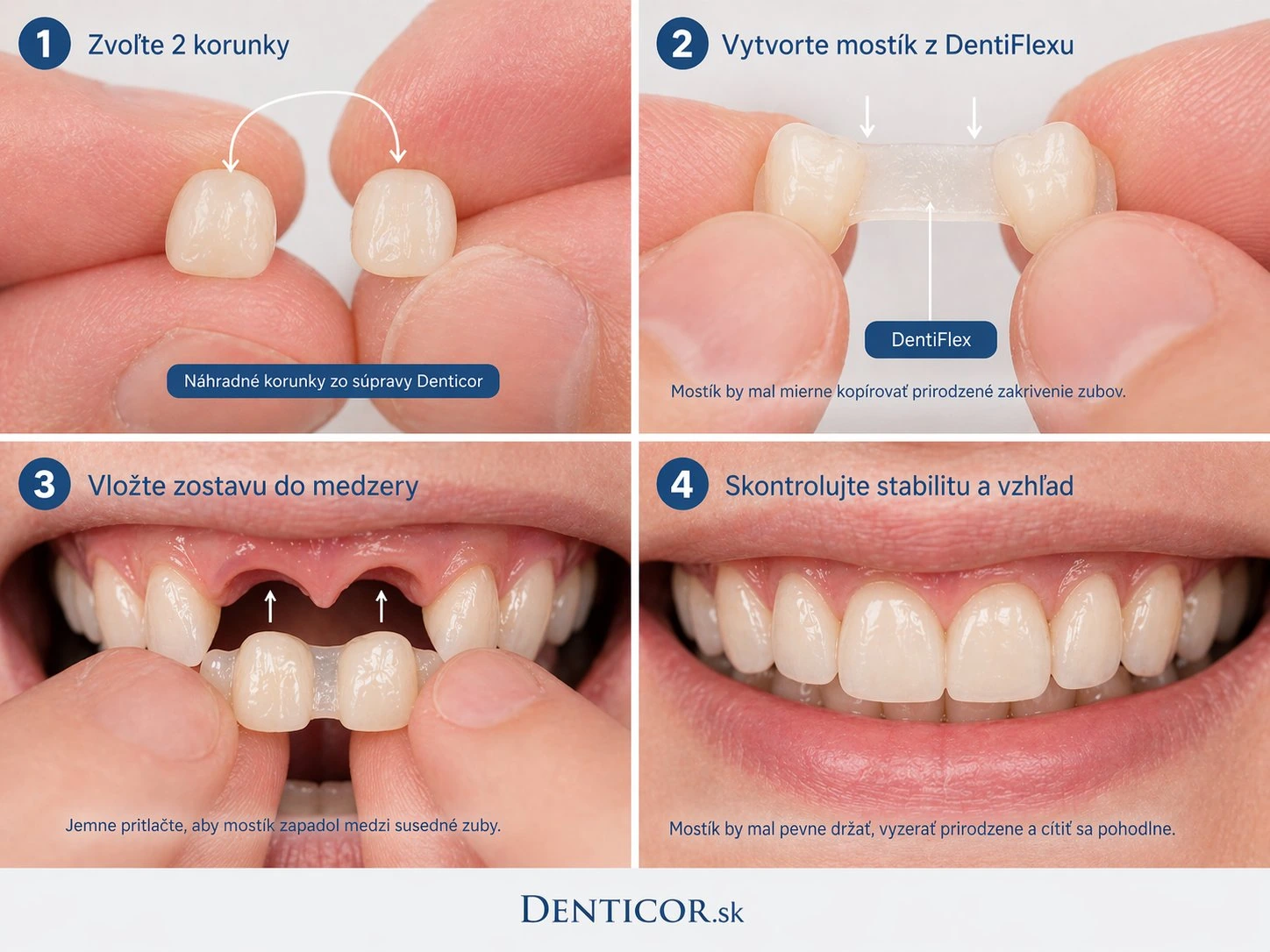 Cum funcționează Denticor în cazul lipsei a două premolare inferioare