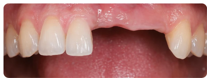 Procedură vizuală pentru două premolare și un molar inferior – principiul inserării punții Denticor cu dinți noi și modelarea acesteia în jurul dinților înconjurători