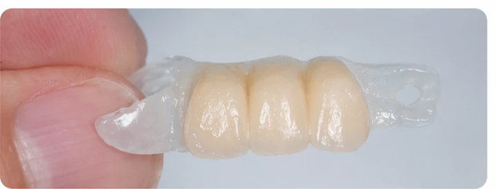 Procedură vizuală pentru două premolare și un molar inferior – principiul inserării punții Denticor cu dinți noi și modelarea acesteia în jurul dinților înconjurători