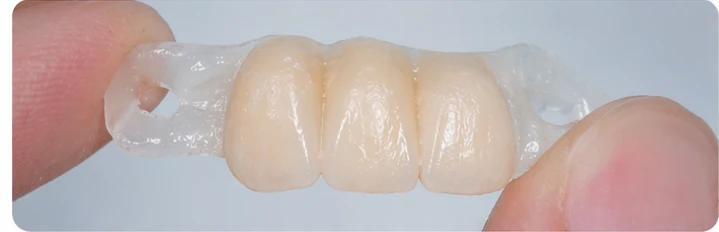 Procedură vizuală pentru două premolare și un molar inferior – principiul inserării punții Denticor cu dinți noi și modelarea acesteia în jurul dinților înconjurători