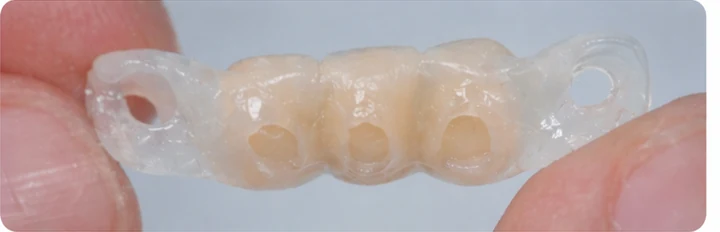 Procedură vizuală pentru două premolare și un molar inferior – principiul inserării punții Denticor cu dinți noi și modelarea acesteia în jurul dinților înconjurători