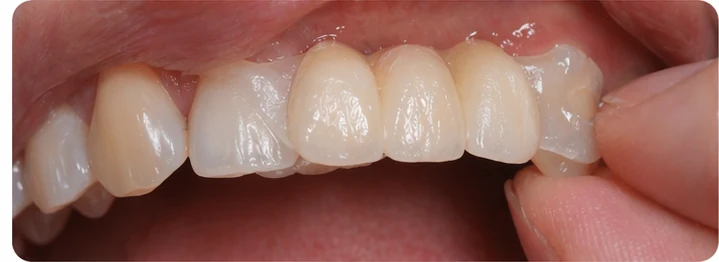 Procedură vizuală pentru două premolare și un molar inferior – principiul inserării punții Denticor cu dinți noi și modelarea acesteia în jurul dinților înconjurători