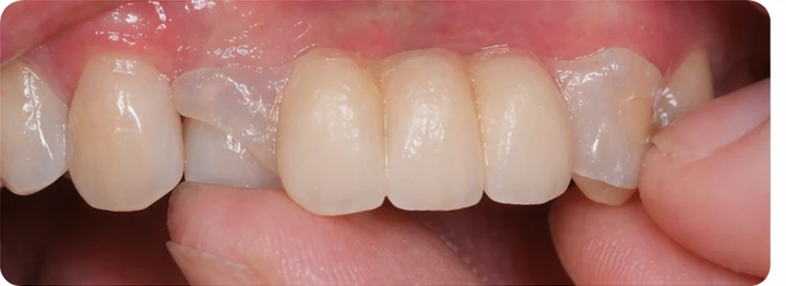 Procedură vizuală pentru două premolare și un molar inferior – principiul inserării punții Denticor cu dinți noi și modelarea acesteia în jurul dinților înconjurători