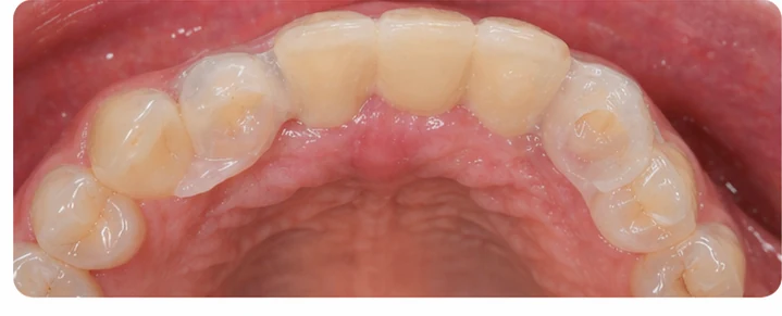 Procedură vizuală pentru două premolare și un molar inferior – principiul inserării punții Denticor cu dinți noi și modelarea acesteia în jurul dinților înconjurători