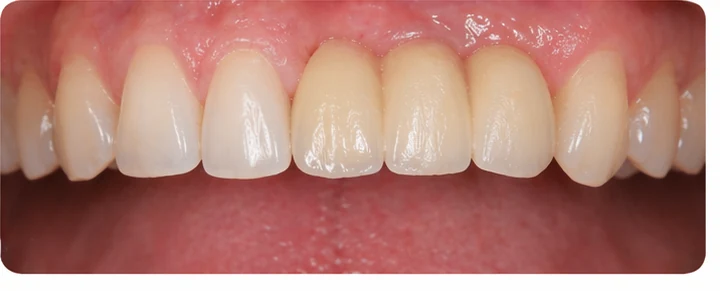 Procedură vizuală pentru două premolare și un molar inferior – principiul inserării punții Denticor cu dinți noi și modelarea acesteia în jurul dinților înconjurători