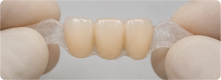 Trei coroane inserate în DentiFlex