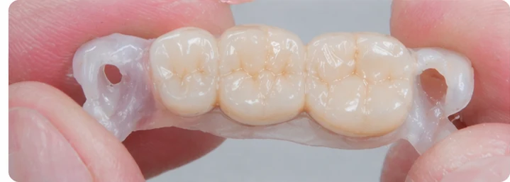 Procedura vizuală pentru cei trei dinți din spate de jos — principiul inserării punții Denticor cu dinți noi și modelarea acesteia în jurul dinților înconjurători
