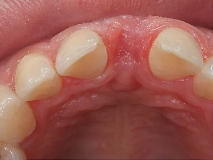 Vedere din spate a dinților frontali: DentiFlex formează un sistem de fixare în spatele dinților învecinați