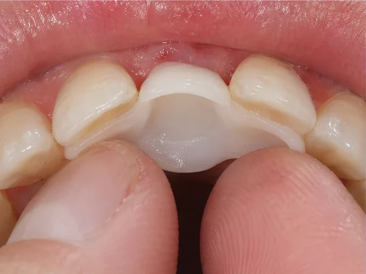 Vedere din spate a dinților frontali: DentiFlex formează un sistem de fixare în spatele dinților învecinați