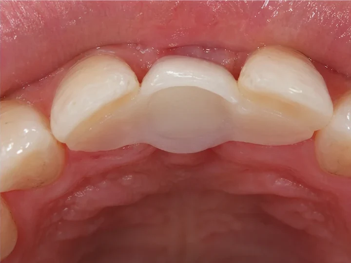 Vedere din spate a dinților frontali: DentiFlex formează un sistem de fixare în spatele dinților învecinați