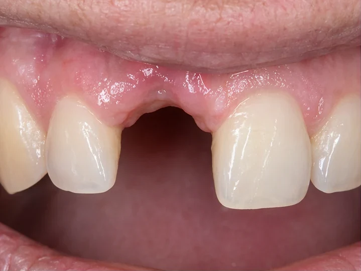 Vedere frontală: dinte frontal lipsă, coroană în DentiFlex, inserare între dinții înconjurători și rezultatul