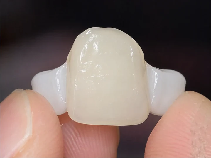 Vedere frontală: dinte frontal lipsă, coroană în DentiFlex, inserare între dinții înconjurători și rezultatul