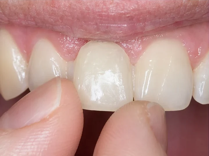 Vedere frontală: dinte frontal lipsă, coroană în DentiFlex, inserare între dinții înconjurători și rezultatul