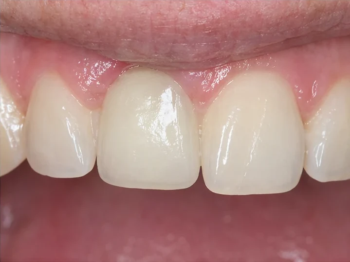 Vedere frontală: dinte frontal lipsă, coroană în DentiFlex, inserare între dinții înconjurători și rezultatul