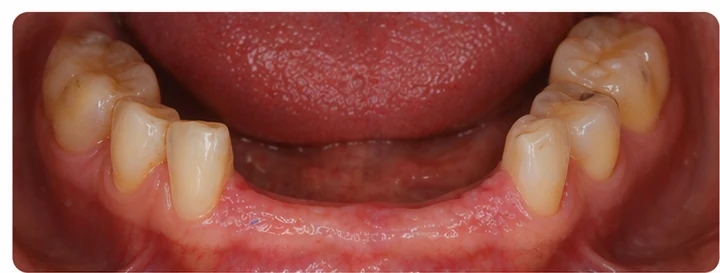 Procedură vizuală pentru două premolari și un molar superior – principiul inserării punții Denticor cu dinți noi și modelarea acesteia în jurul dinților învecinați
