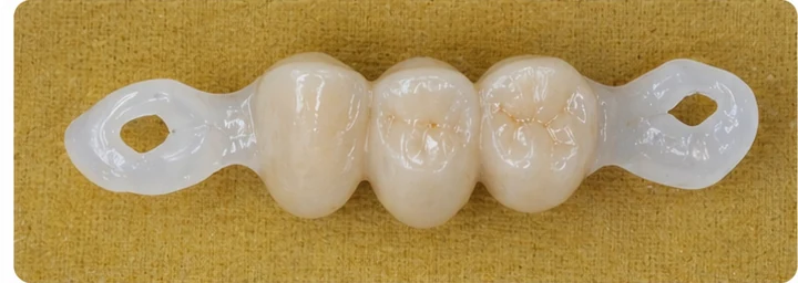 Procedură vizuală pentru două premolari și un molar superior – principiul inserării punții Denticor cu dinți noi și modelarea acesteia în jurul dinților învecinați