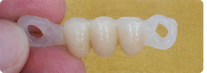 Procedură vizuală pentru două premolari și un molar superior – principiul inserării punții Denticor cu dinți noi și modelarea acesteia în jurul dinților învecinați