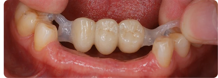 Procedură vizuală pentru două premolari și un molar superior – principiul inserării punții Denticor cu dinți noi și modelarea acesteia în jurul dinților învecinați