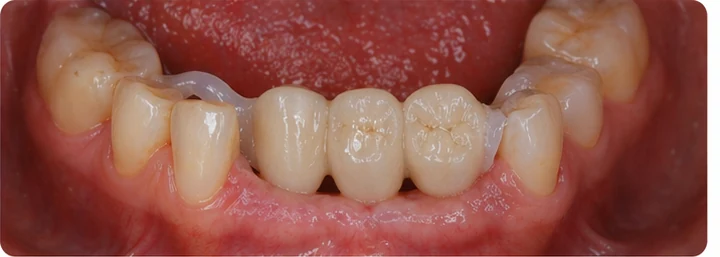 Procedură vizuală pentru două premolari și un molar superior – principiul inserării punții Denticor cu dinți noi și modelarea acesteia în jurul dinților învecinați