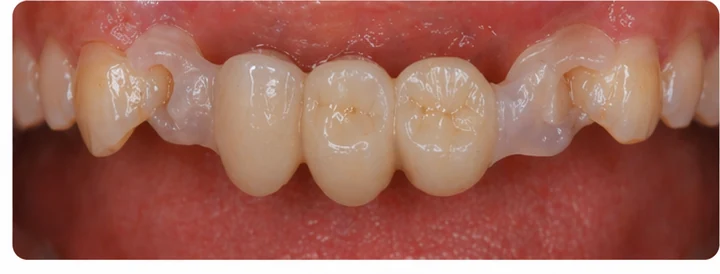 Procedură vizuală pentru două premolari și un molar superior – principiul inserării punții Denticor cu dinți noi și modelarea acesteia în jurul dinților învecinați