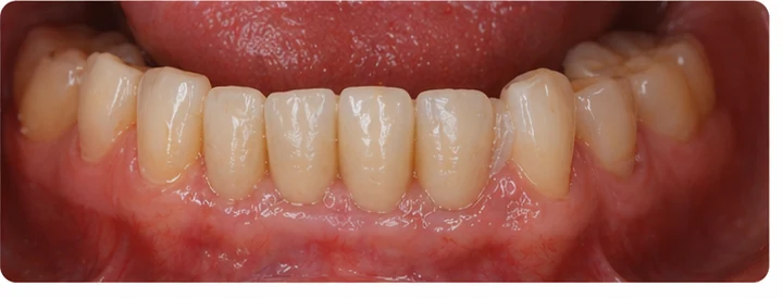 Procedură vizuală pentru două premolari și un molar superior – principiul inserării punții Denticor cu dinți noi și modelarea acesteia în jurul dinților învecinați