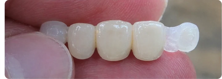 Demonstrație de adaptare Denticor: poziționarea piesei și modelarea sprijinului din DentiFlex · 3