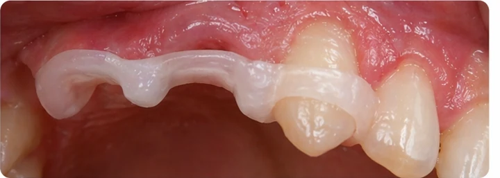 Demonstrație de adaptare Denticor: poziționarea piesei și modelarea sprijinului din DentiFlex · 6