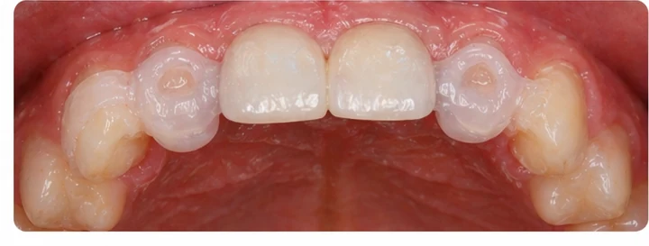 Demonstrație de adaptare Denticor: poziționarea piesei și modelarea sprijinului din DentiFlex · 7
