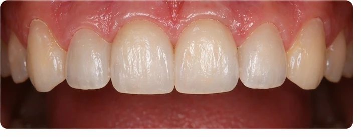 Demonstrație de adaptare Denticor: poziționarea piesei și modelarea sprijinului din DentiFlex · 8