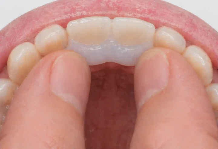 Denticor pentru cei doi incisivi centrali superiori – vedere din spate de la nivelul palatului: forma punții și așezarea în spatele dinților noi