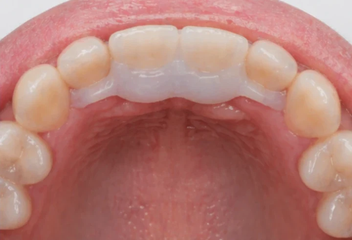 Denticor pentru cei doi incisivi centrali superiori – vedere din spate de la nivelul palatului: forma punții și așezarea în spatele dinților noi