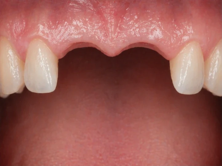 Denticor pentru cei doi incisivi centrali superiori – vedere din față: spațiu liber, proteză pregătită, inserare și rezultat