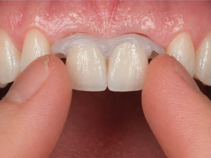 Denticor pentru cei doi incisivi centrali superiori – vedere din față: spațiu liber, proteză pregătită, inserare și rezultat