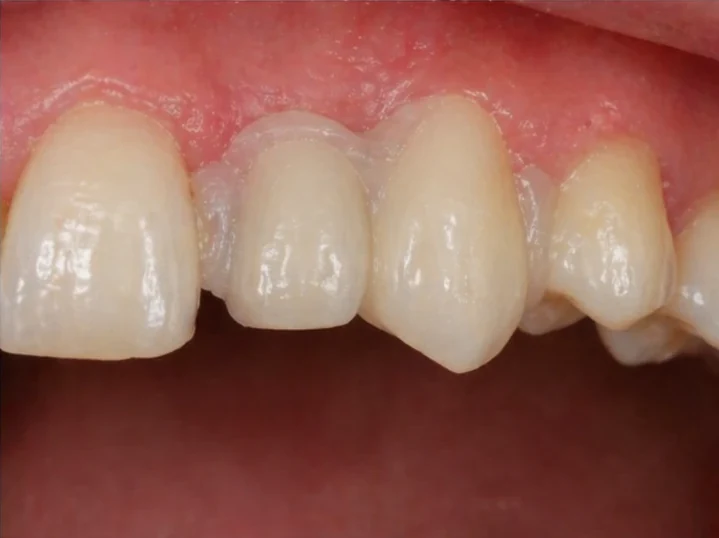 Piesa Denticor pentru incisiv lateral superior și canin – vedere din față, introducerea sprijinului și rezultatul
