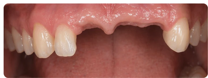 Demonstrație de adaptare Denticor: poziționarea piesei și modelarea sprijinului din DentiFlex · 1