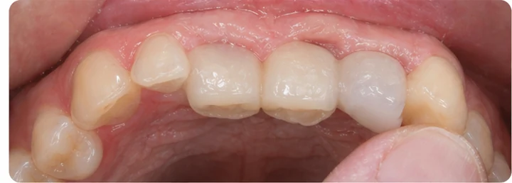 Demonstrație de adaptare Denticor: poziționarea piesei și modelarea sprijinului din DentiFlex · 5