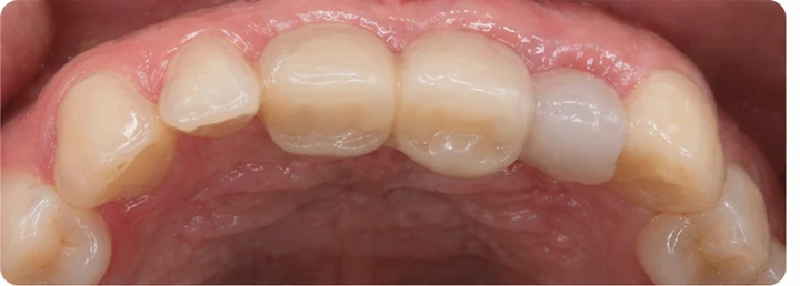 Demonstrație de adaptare Denticor: poziționarea piesei și modelarea sprijinului din DentiFlex · 6