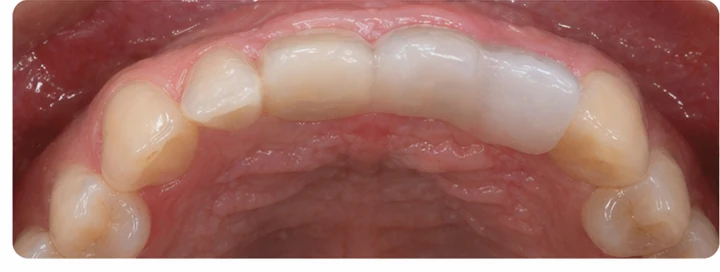 Demonstrație de adaptare Denticor: poziționarea piesei și modelarea sprijinului din DentiFlex · 7