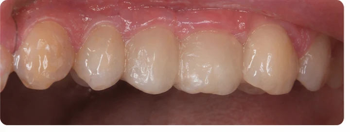 Demonstrație de adaptare Denticor: poziționarea piesei și modelarea sprijinului din DentiFlex · 8