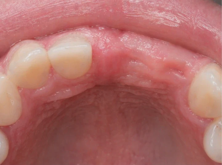 Denticor pentru incisivii centrali și laterali superiori – vedere din spate de la palat: forma punții și așezarea în spatele dinților noi