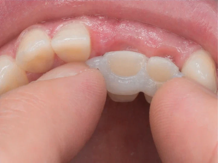 Denticor pentru incisivii centrali și laterali superiori – vedere din spate de la palat: forma punții și așezarea în spatele dinților noi