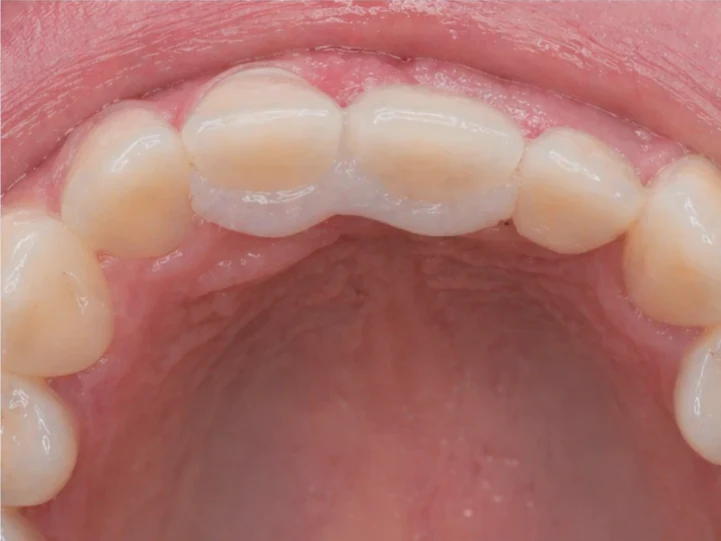 Denticor pentru incisivii centrali și laterali superiori – vedere din spate de la palat: forma punții și așezarea în spatele dinților noi