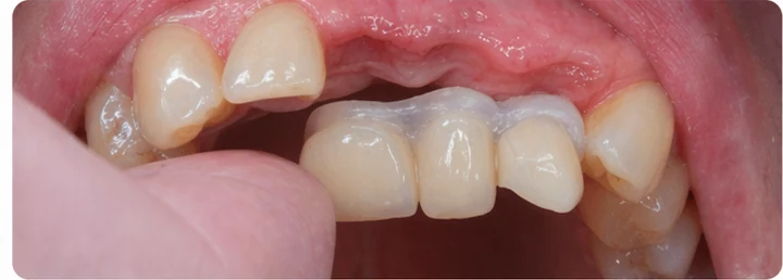 Procedura vizuală pentru trei dinți adiacenți din arcada superioară – principiul inserării punții Denticor cu dinți noi și modelarea acesteia în funcție de dinții înconjurători