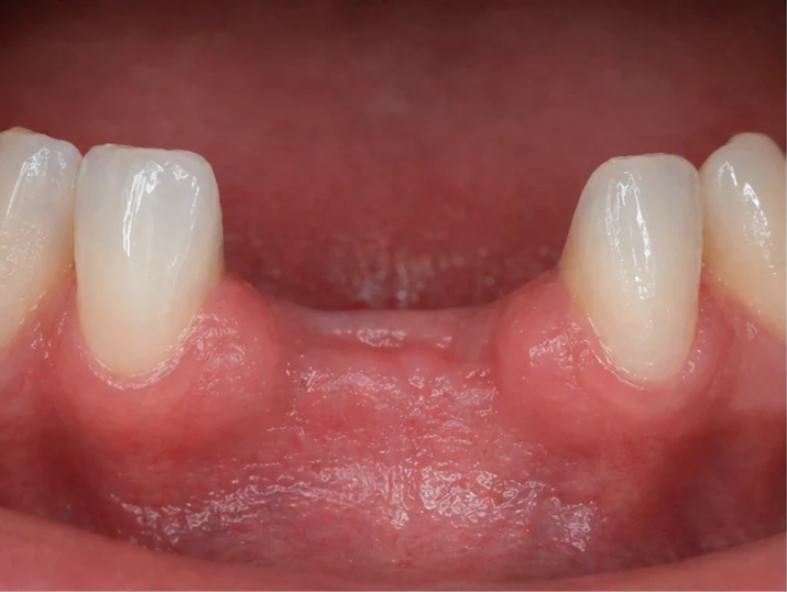 Denticor – înlocuire rapidă a celor doi incisivi frontali inferiori: spațiu liber, punte DentiFlex pregătită cu doi dinți, inserare ca un tot unitar și rezultat