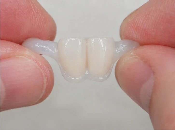Denticor – înlocuire rapidă a celor doi incisivi frontali inferiori: spațiu liber, punte DentiFlex pregătită cu doi dinți, inserare ca un tot unitar și rezultat